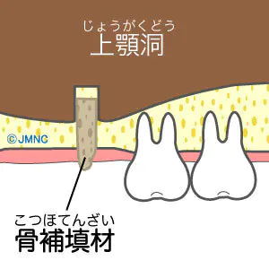 ソケットリフトの治療イラスト